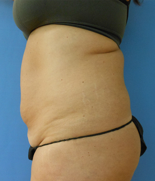 Abdominal Liposuction, San Diego & Carlsbad