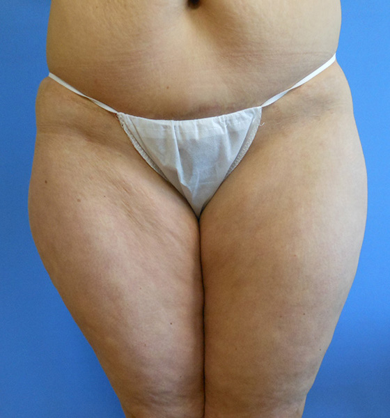 Inner Thigh Liposuction, Bakersfield & Orange County