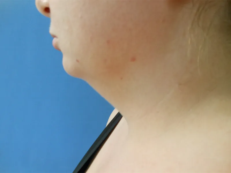 Neck Before & After Gallery - Patient 185847525 - Image 1