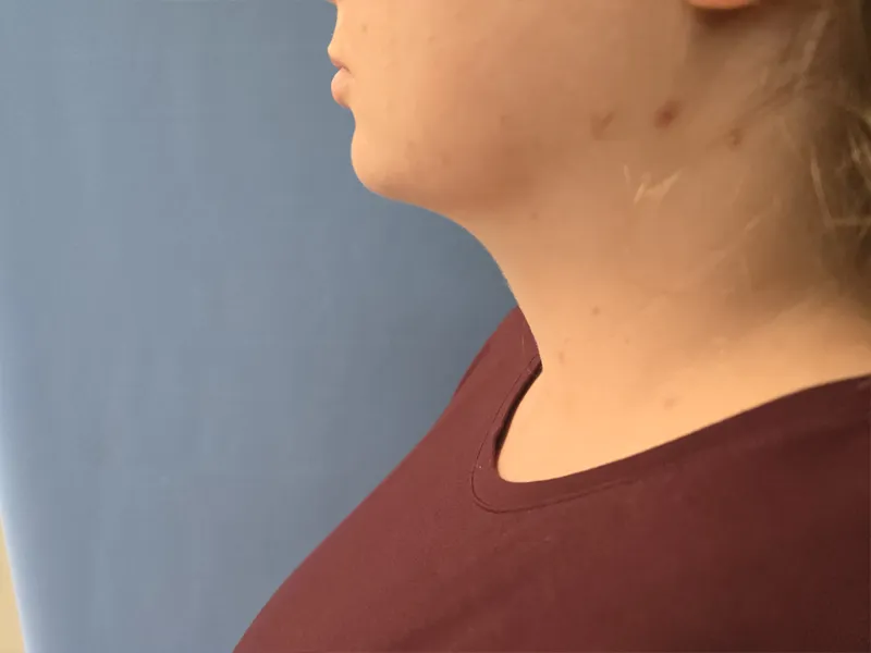 Neck Before & After Gallery - Patient 185847525 - Image 2