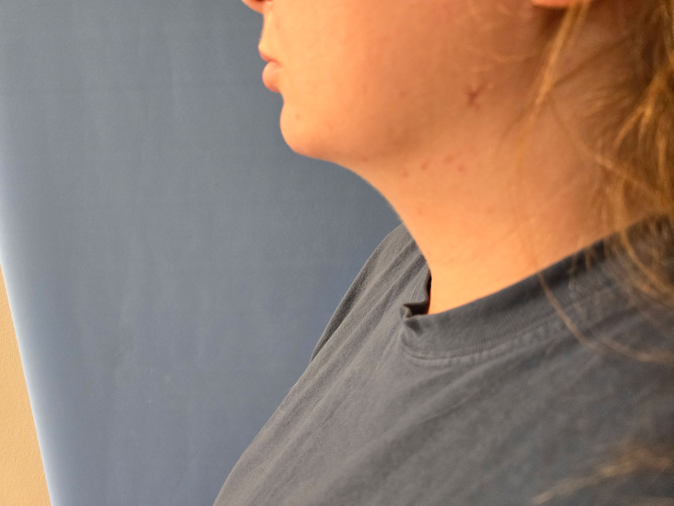 Neck Before & After Gallery - Patient 51821658 - Image 2