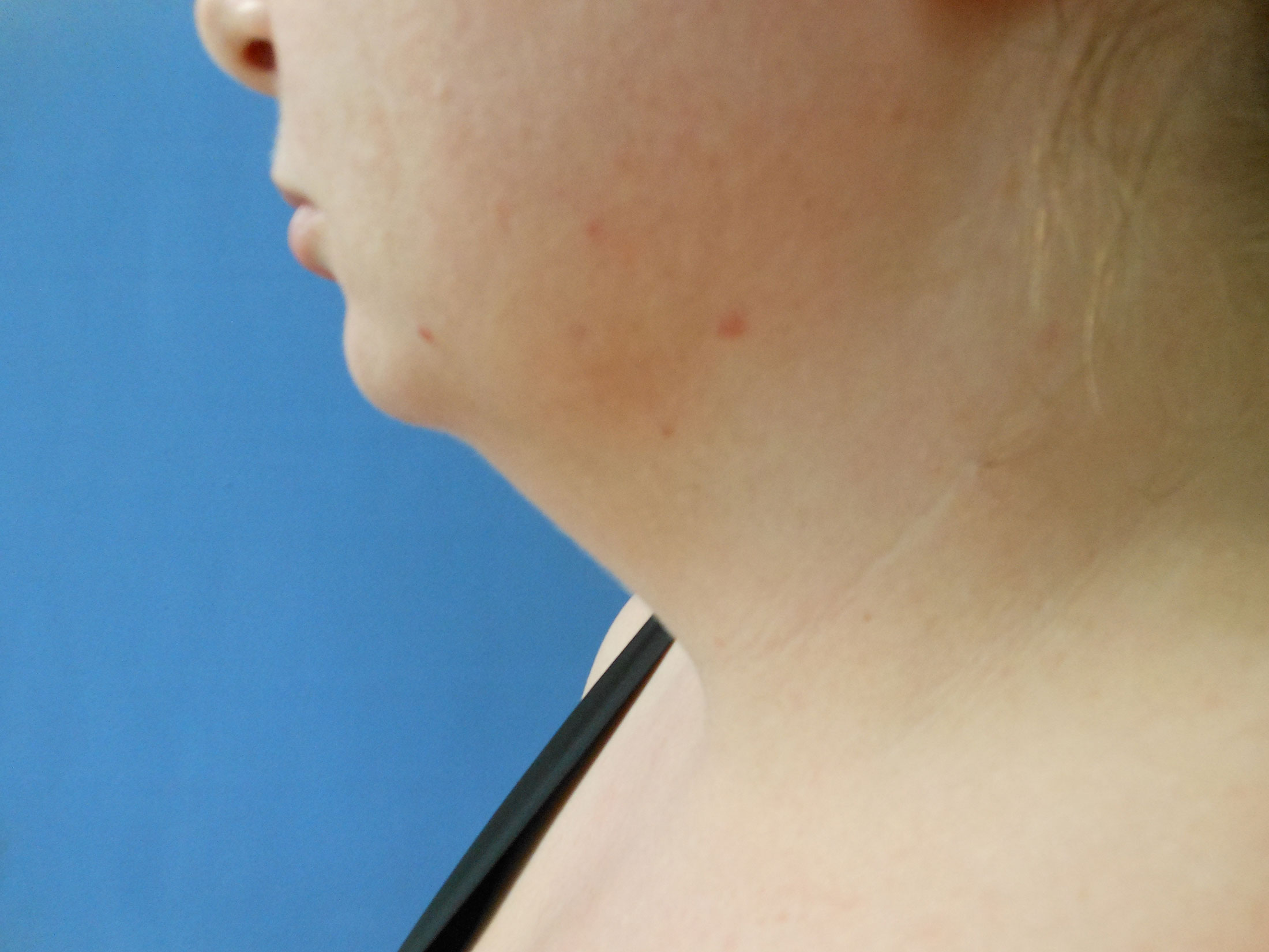 Neck Before & After Gallery - Patient 51821658 - Image 1