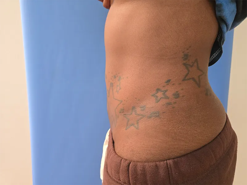 Abdomen Before & After Gallery - Patient 51821762 - Image 4