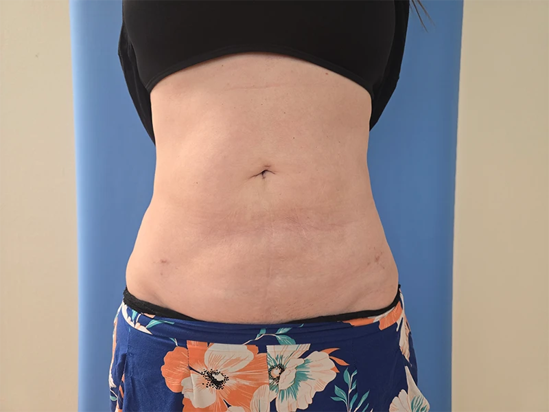 Abdomen Before & After Gallery - Patient 51821763 - Image 2