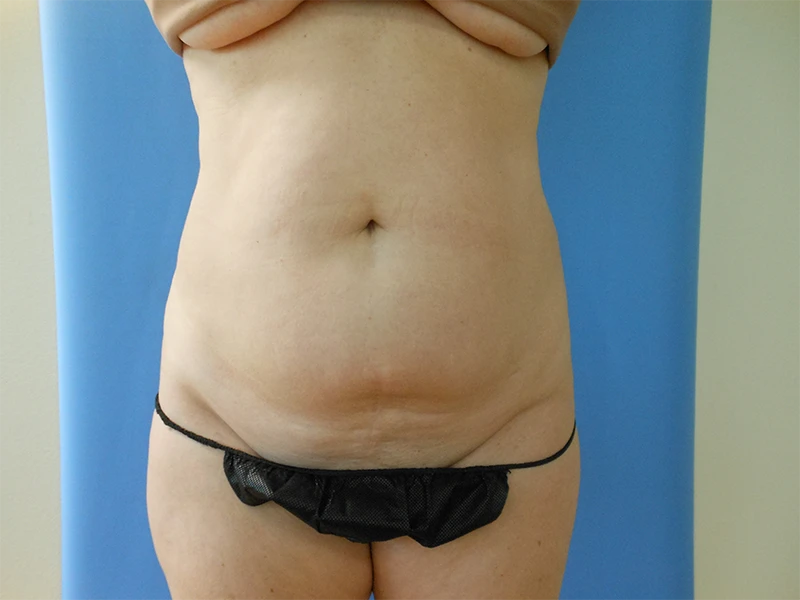 Abdomen Before & After Gallery - Patient 51821763 - Image 1