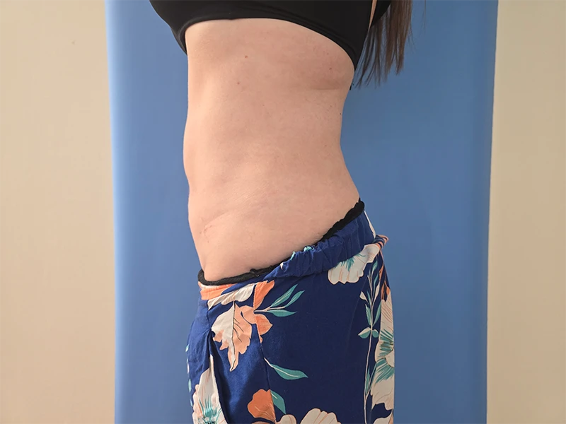 Abdomen Before & After Gallery - Patient 51821763 - Image 4