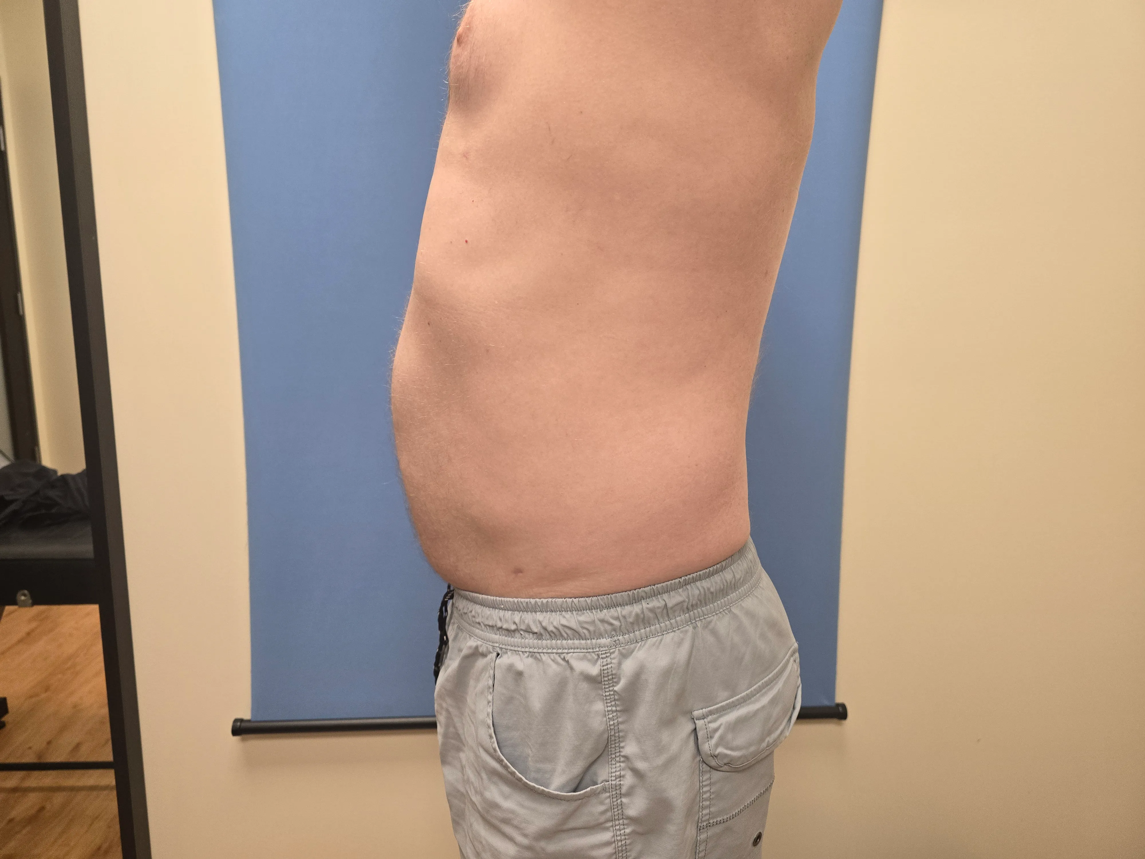 Abdomen Before & After Gallery - Patient 51821761 - Image 2