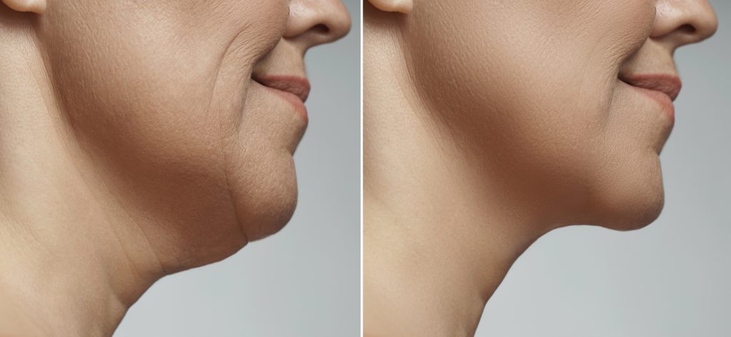 Neck & Chin Lipo Results on a women